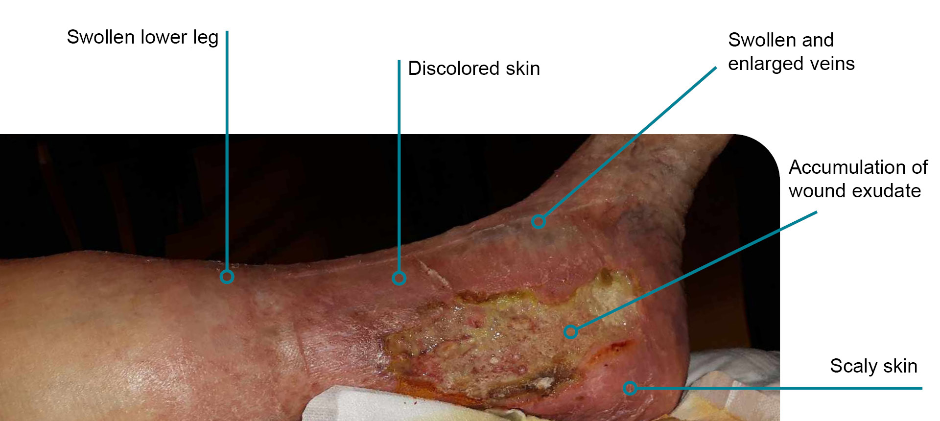 Image of a venous leg ulcer with signs of the symptoms 