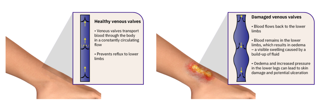 A picture describing damaged and healthy venous valves causing venous insufficiency