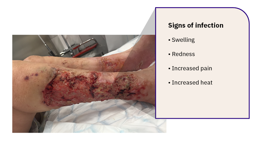 Image of an infected venous leg ulcer 