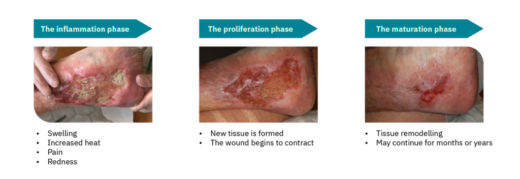 A picture of phases in wound healing process