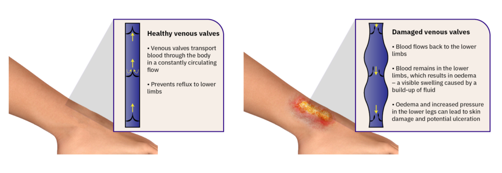 Damaged venous valves causes insuffiency and swelling in lover leg.