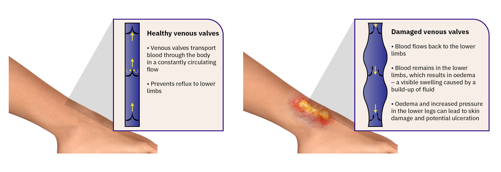 Guiding to venous leg ulcer management and compression therapy