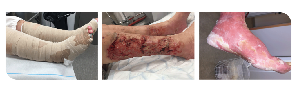 Pictures of venous leg ulcers; leakage and maceration.