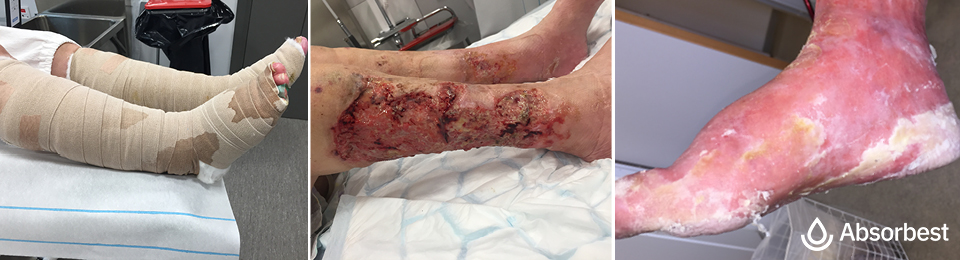 exudating wound in inflammation phase with maceration.
