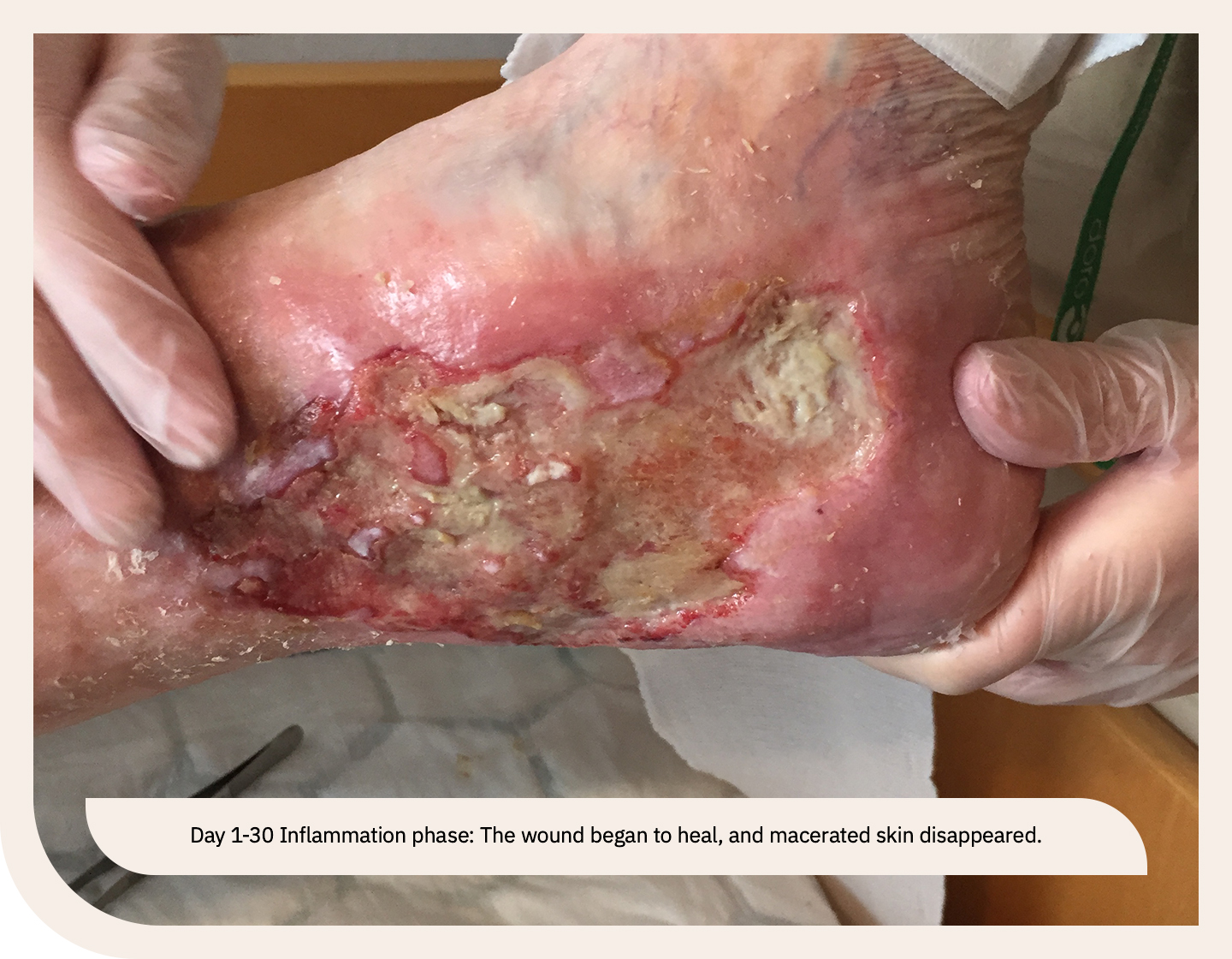Leg ulcer in inflammation phase