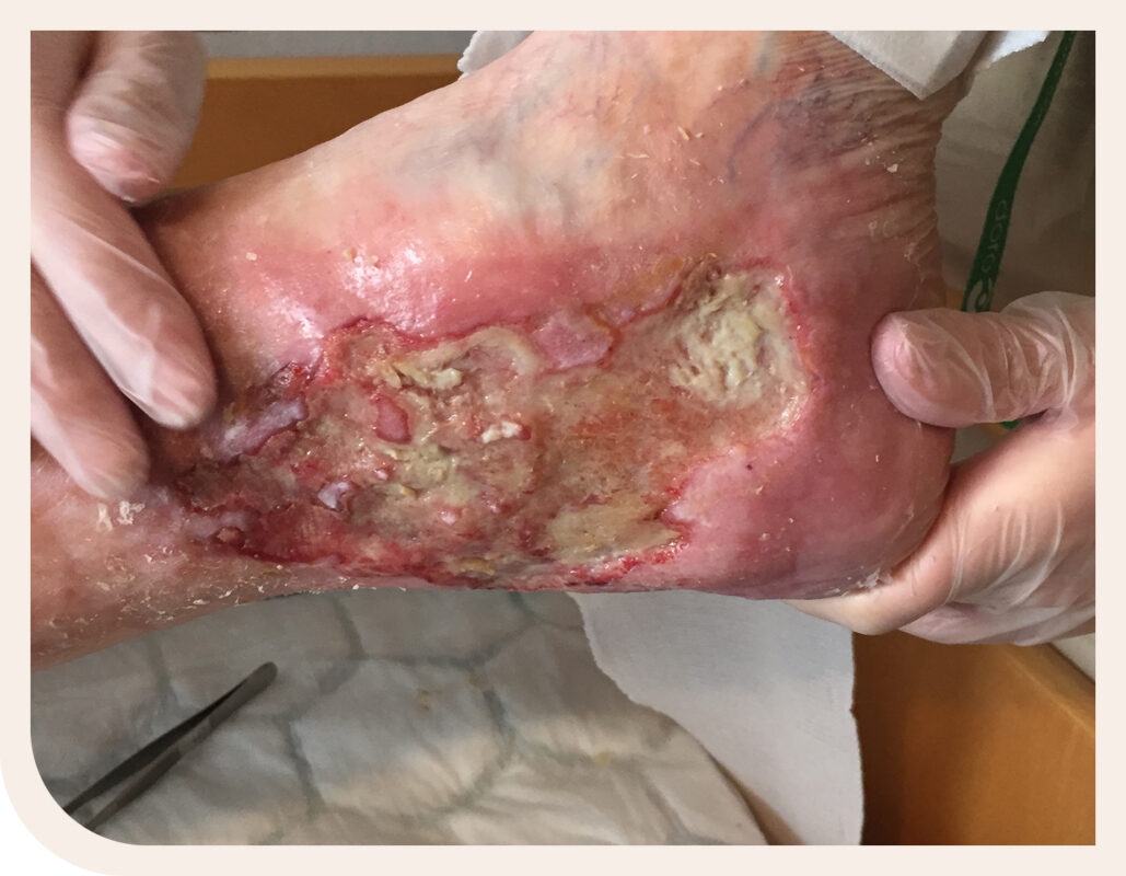 yellow fibrin and wound cleaning on leg ulcer