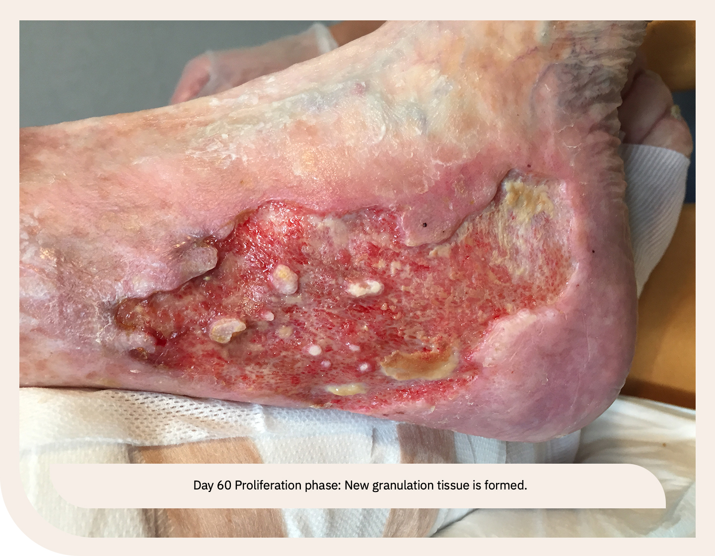 leg ulcer wound in proliferation phase