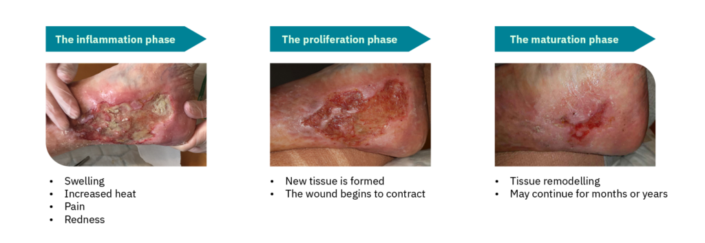 phases in the wound healing process