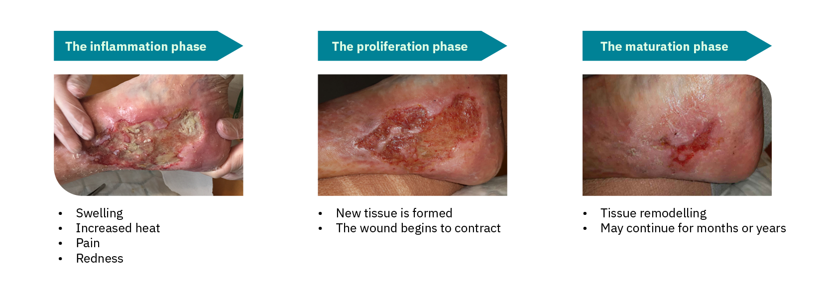 phaeses in wound healing process for leg ulcer