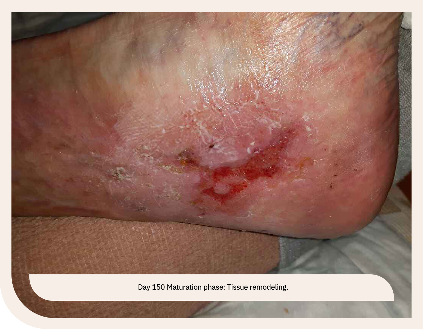 leg ulcer wound in maturation phase