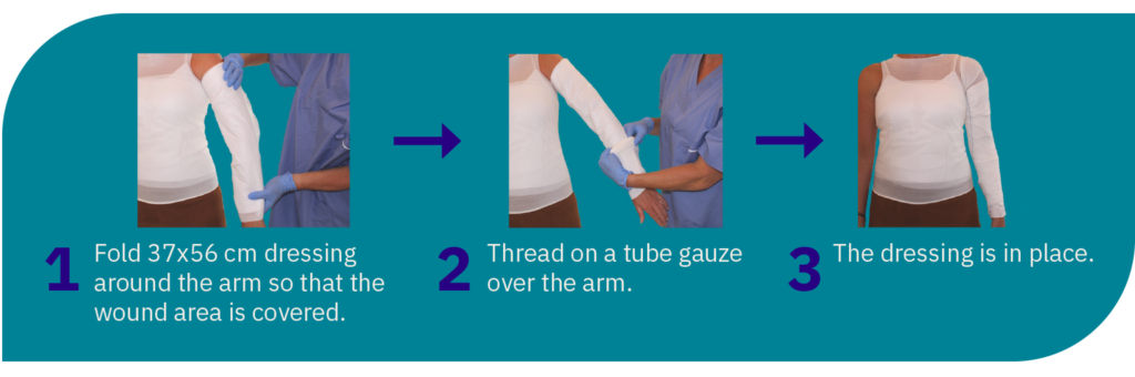 A large wound dressing wrapped around an arm.