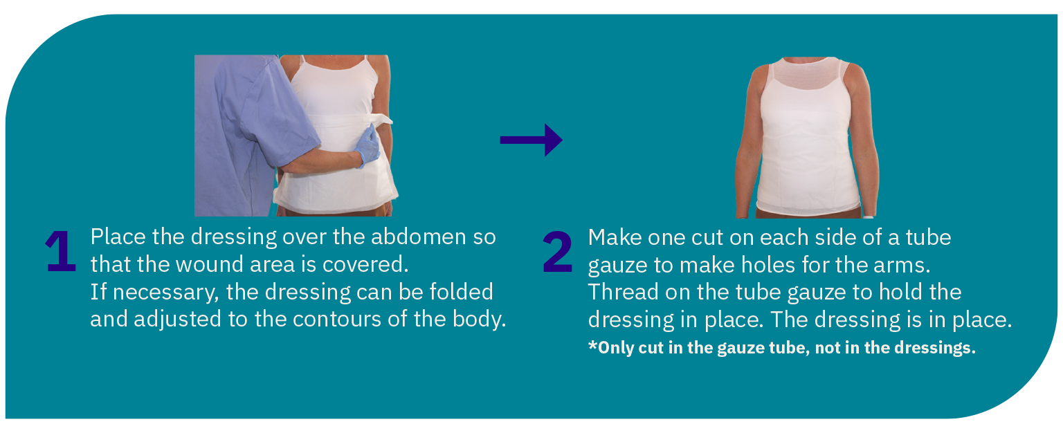 Large dressing for abdominal wound