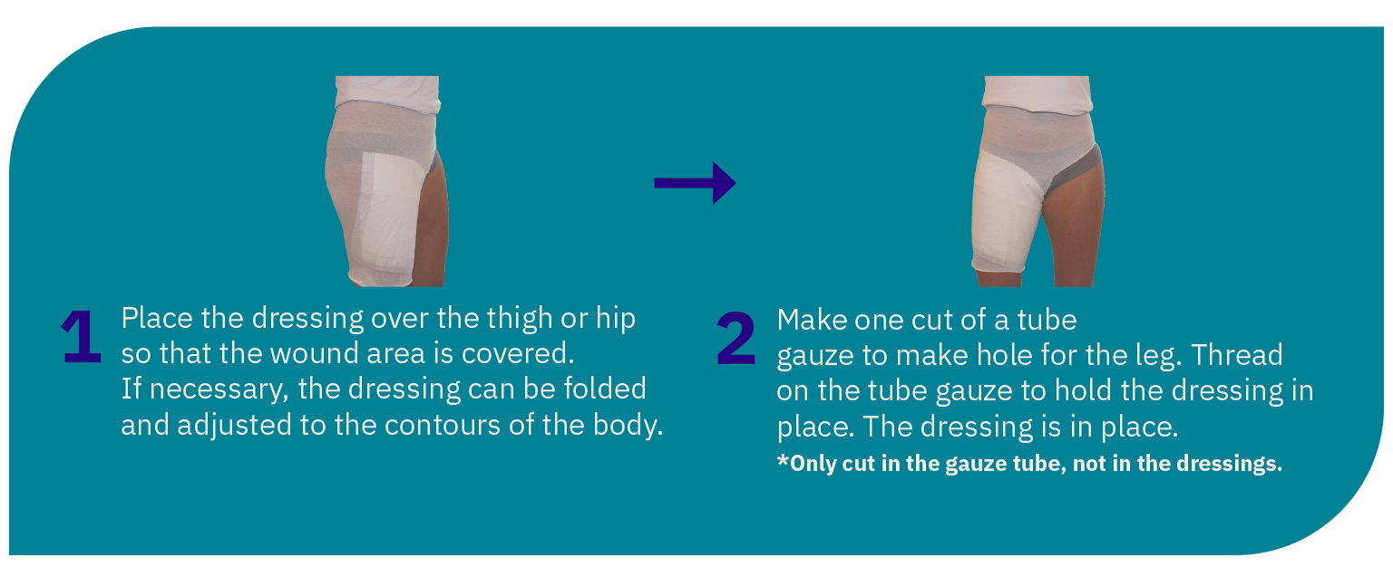 Dress a wound on a hip or thigh