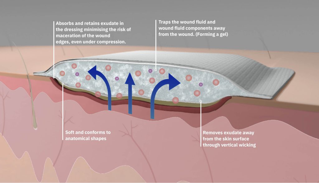 Retention and absorption in a superabsorbent dressing