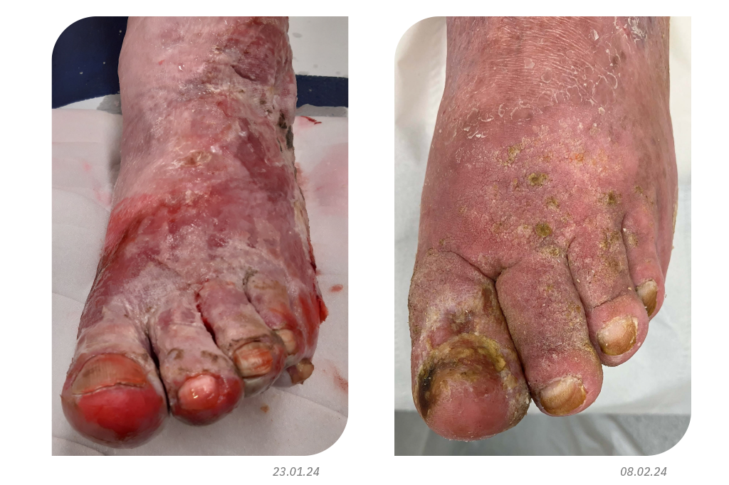 A chronic ulcer with wet, leaky toes.