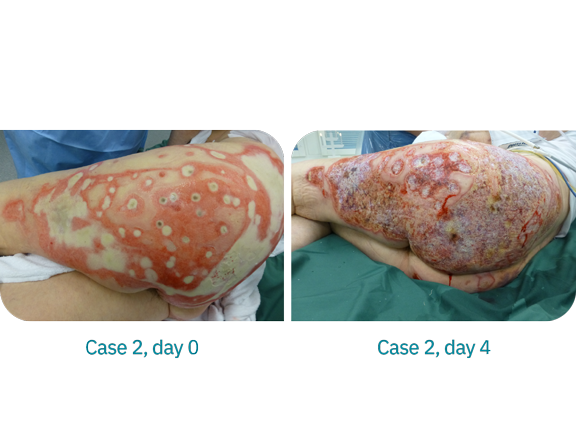 Case2-Burn-injury-treated-with-a-superabsorbent-dressing