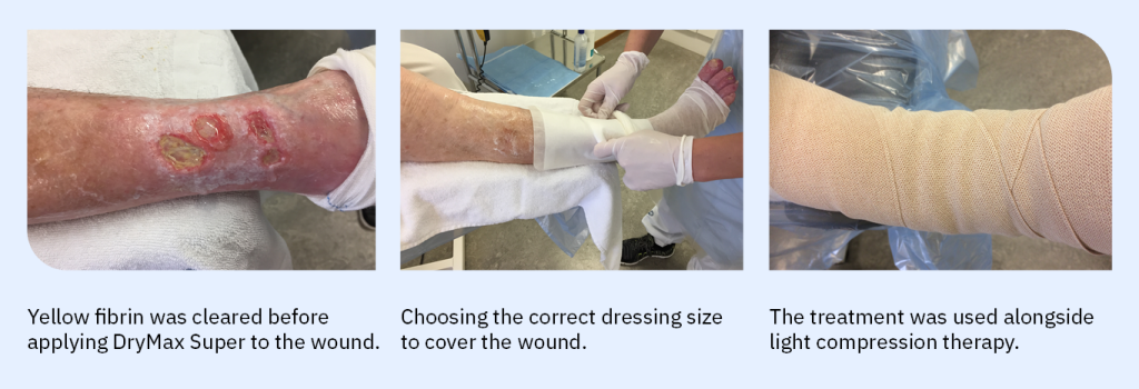 Treatment routine mixed aetiology leg ulcer
