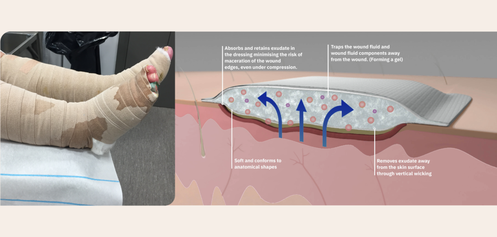 leakage from a dressing and an illustration of capacities of a wound dressing.