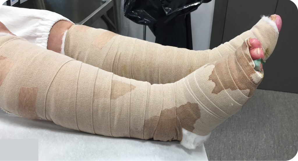 leakage from a wound dressing.