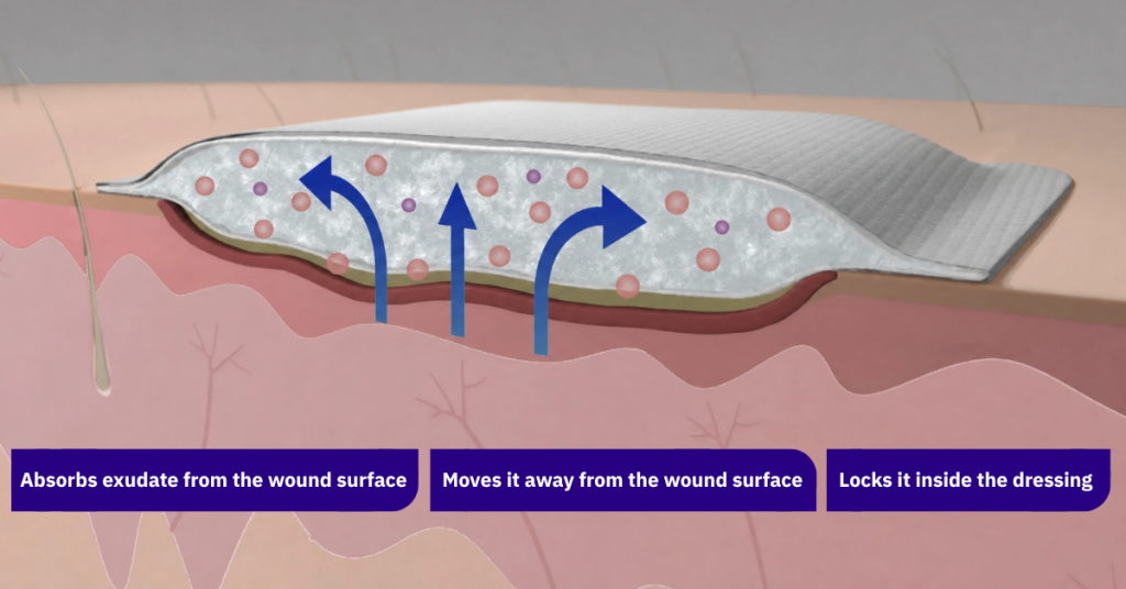 A superabsorbent dressing, DryMax Super, absorbs wound exudate.