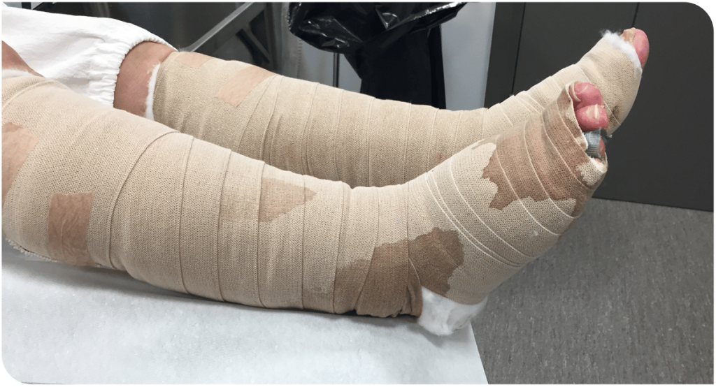 leakage from dressing under compression therapy.