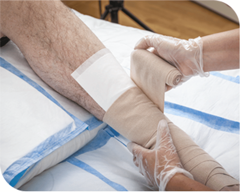compression treatment on leg ulcer.